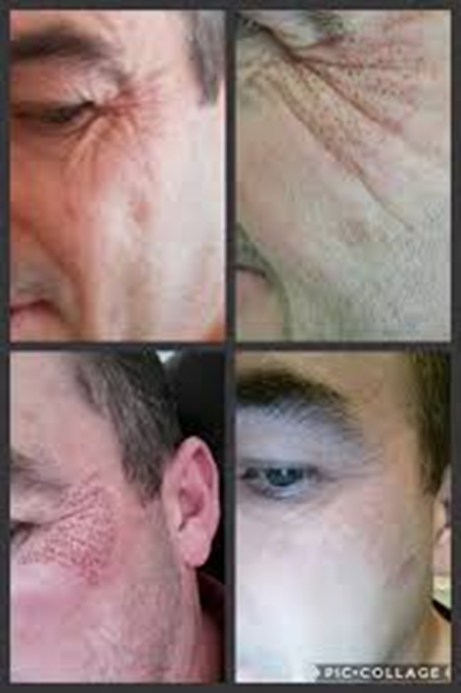 Profesional Multifunction 2 In 1 Ozone Plasma Pen Cold Plasma Pen Machine Jet Plasma Pen Machine