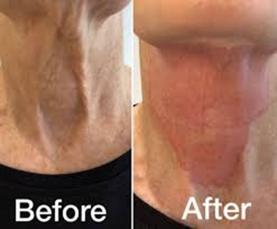 Profesional Multifunction 2 In 1 Ozone Plasma Pen Cold Plasma Pen Machine Jet Plasma Pen Machine