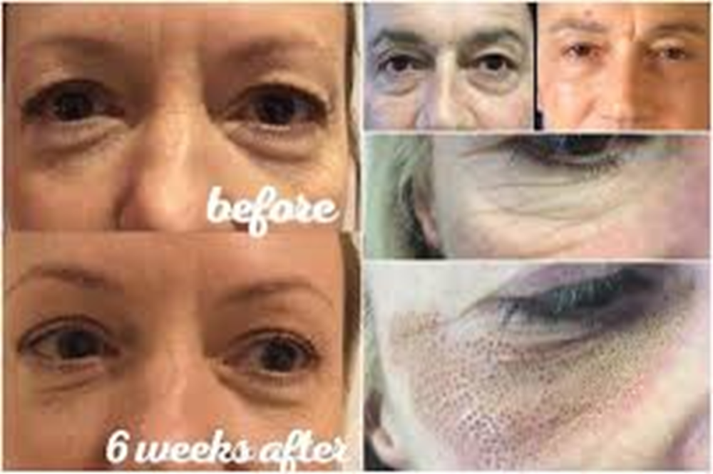 Profesional Multifunction 2 In 1 Ozone Plasma Pen Cold Plasma Pen Machine Jet Plasma Pen Machine