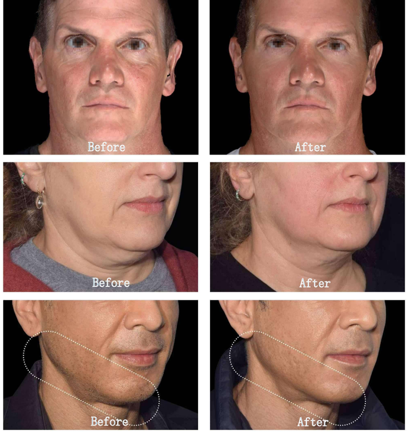 EMRF High-intensity Facial Electromagnetic Stimulation HIFES Mono-polar Radio Frequency Machine Face Skin Lifting Tighten