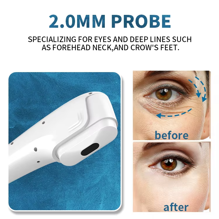 2 in 1 7D HIFO RF Machine 7D HlFU Smas Anti Wrinkle Face Lifting Machine / Microneedling Fractional RF Machine with 2 Handles1. Working theory Fractional RF needle system through the special design of many fractional needle point array, the high speed dig