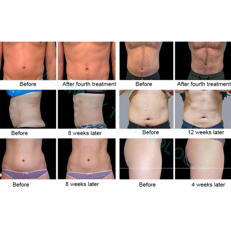 Portable 4 handles neo em sculpt EMS RF body sculpt System