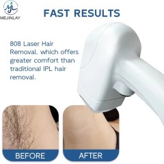 Portable laser hair removal machine for salon use