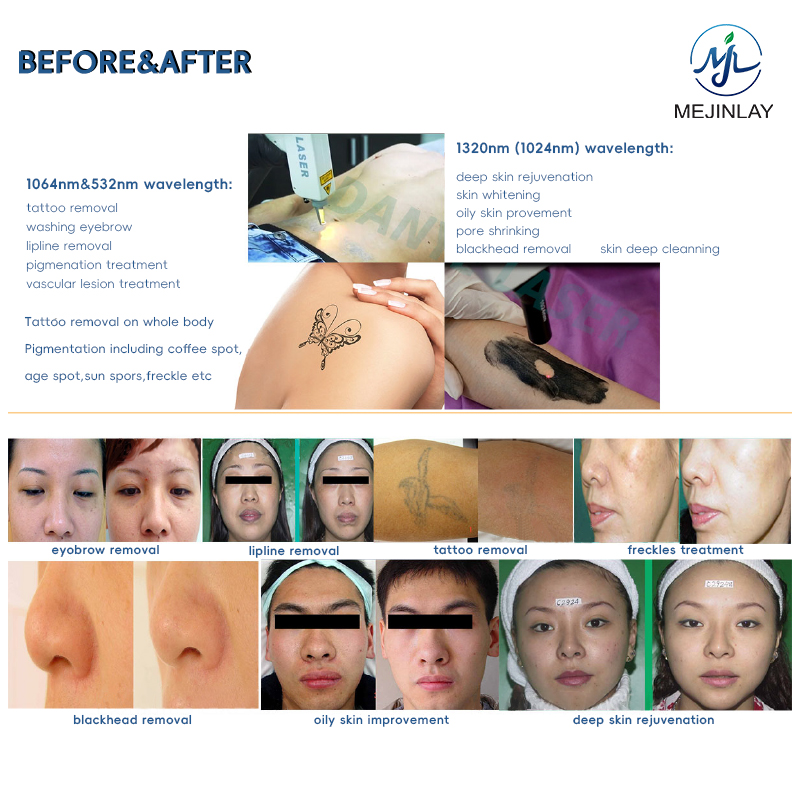 Q switch nd yag laser tattoo removal for skin care