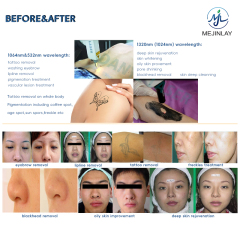Q switch nd yag laser tattoo removal for skin care