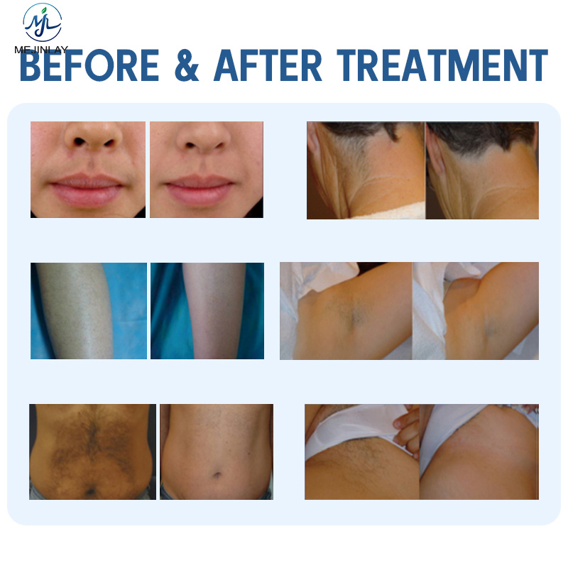 DL203 Painless 808 Laser Permanent Hair Removal Device