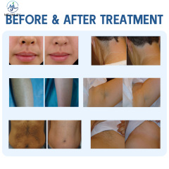 DL203 Painless 808 Laser Permanent Hair Removal Device