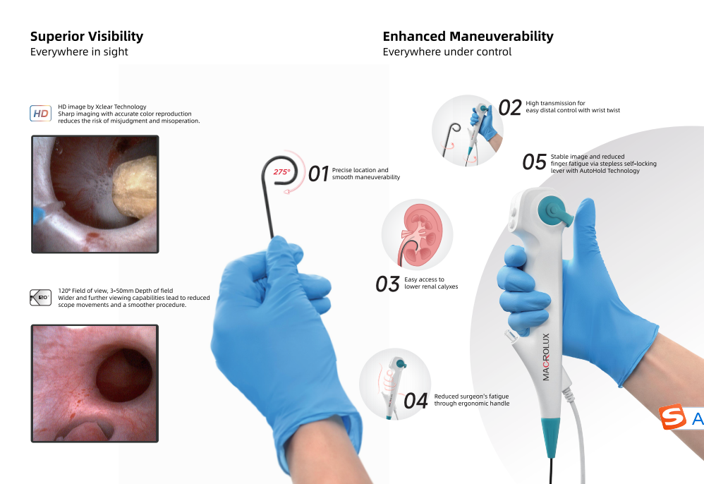 CoralView® U-series Single-Use Digital Flexible Ureteroscope