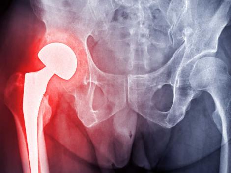 Hip Resurfacing