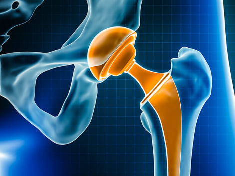Revision Hip Prosthesis