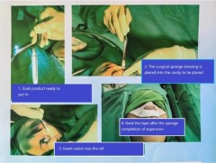 ضمادة الأنف PVA