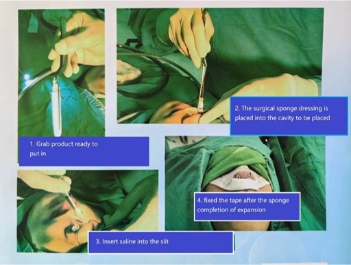 ضمادة الأنف PVA