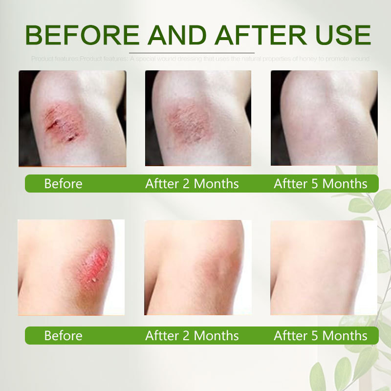 Medical Honey Dressing (Manuka)