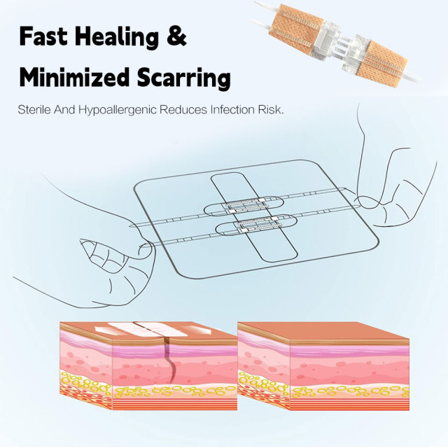 Wundverschlussgerät/Hautklammergeräte