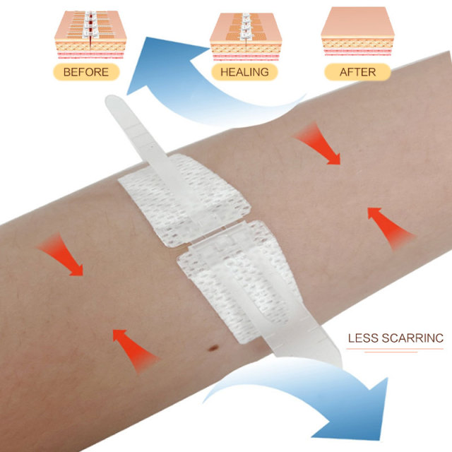 Wundverschlussgerät/Hautklammergeräte
