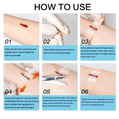 Wundverschlussgerät/Hautklammergeräte