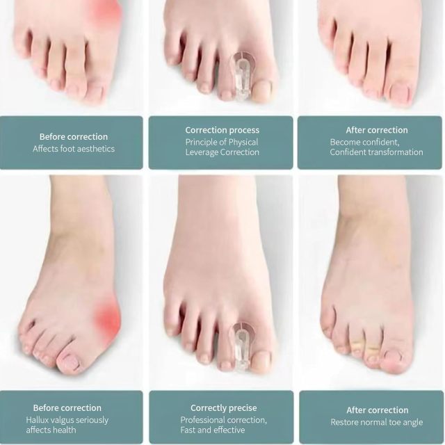 Ballenzehen-Korrektor