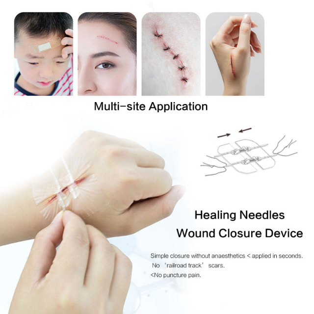 Wundverschlussgerät/Hautklammergeräte