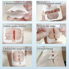 Wundverschlussgerät/Hautklammergeräte