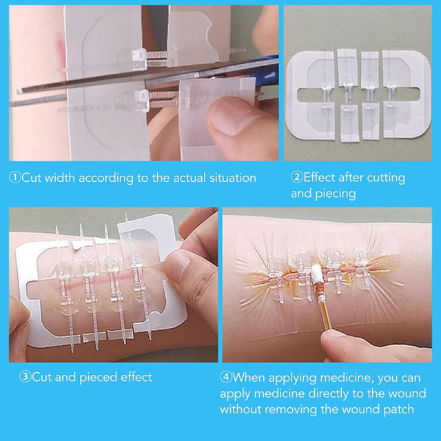 Wundverschlussgerät/Hautklammergeräte
