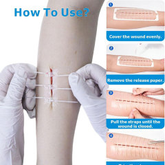 Wound Closure Device/Skin Staplers