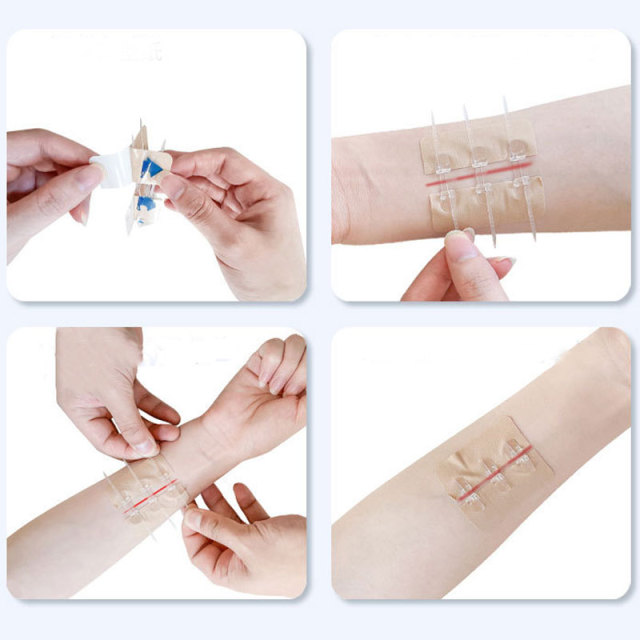 Wundverschlussgerät/Hautklammergeräte