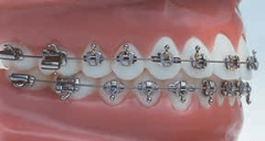Lewis Combo. (Alexander Type* ) Maxillary Arch