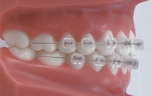 Formula-R (Roth Type) Maxillary Arch