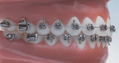 Formula-R (Roth Type) Mandibular Arch