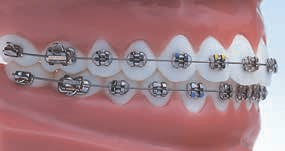Standard Edgewise Maxillary Arch