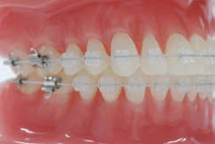 "Crystaline® 8 (OPA-K®)" Ceramic Brackets