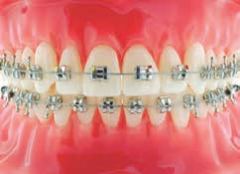 Formula-M (McLaughlin Type* ) Maxillary Arch