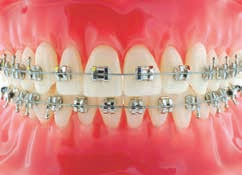Formula-M (McLaughlin Type* ) Maxillary Arch