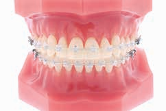 Formula-M (McLaughlin Type* ) Mandibular Arch