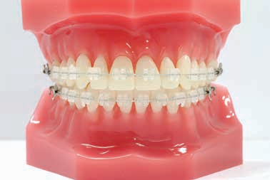 "Crystaline® 8 (OPA-K®)" Ceramic Brackets