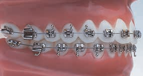 Formula-R (Roth Type) Maxillary Arch