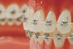 Clippy MicroMini Rhodium Coating Formula-R (Roth Type) Mandibular Arch