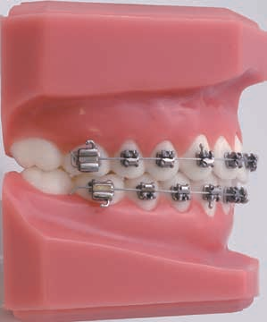 Formula-M (McLaughlin Type* ) Maxillary Arch