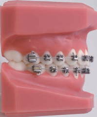 Formula-M (McLaughlin Type* ) Maxillary Arch