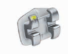 Lewis Combo. (Alexander Type* ) Maxillary Arch