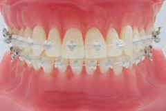 OPA-K Maxillary Arch