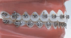 OPA-K Maxillary Arch