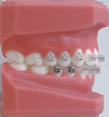 Formula-R (Roth Type) Mandibular Arch