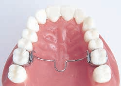 Palatal Arch Bar