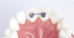 Lingual Retainers