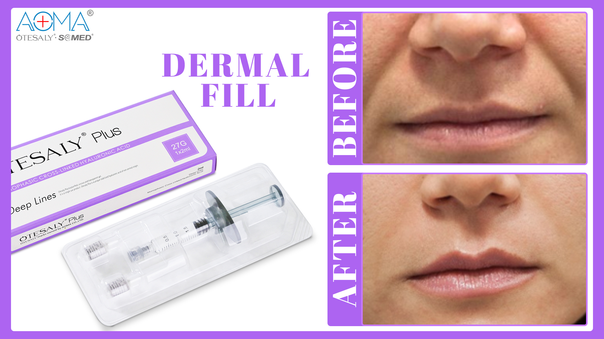 OTESALY® Plus 2ml Deep lines wholesale Hyaluronic Dermal Fillers
