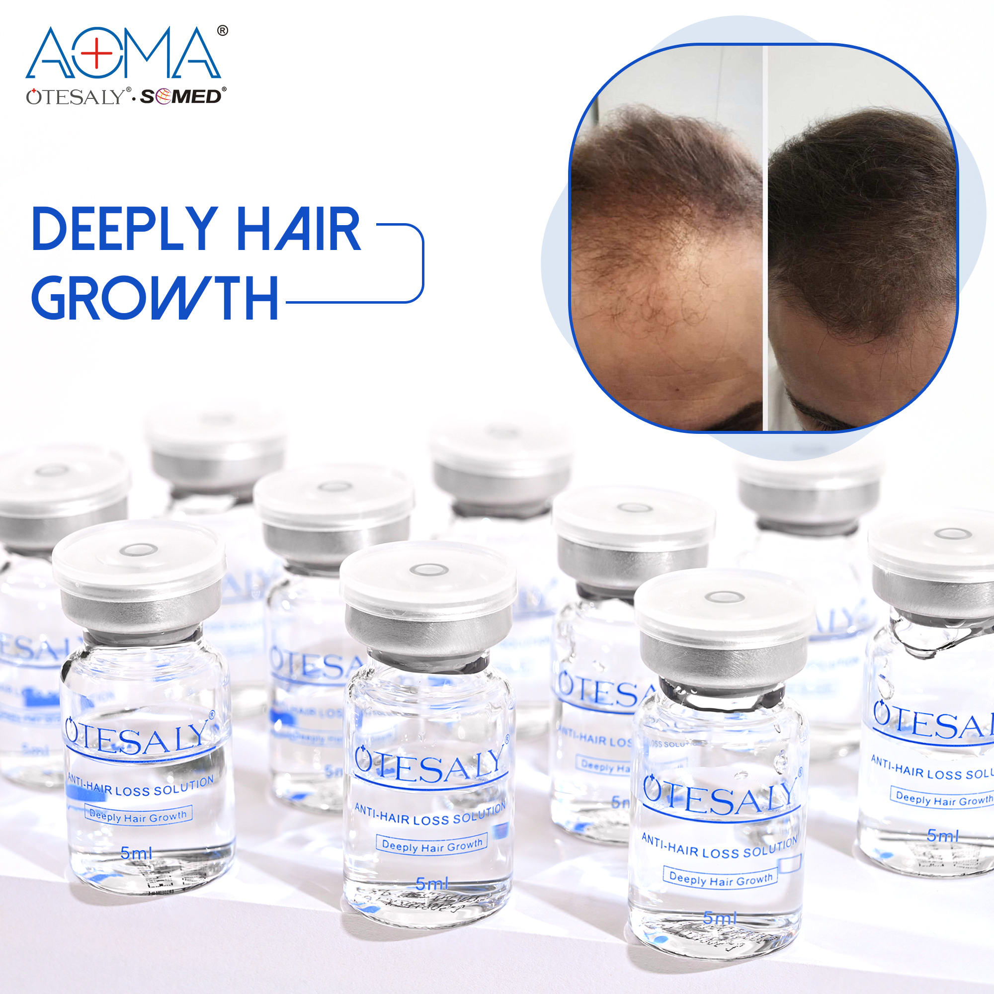 OTESALY® Anti-hair Loss Solution OEM Mesotherapy Solution Hair Rrgrowth Injection Meso Treatment