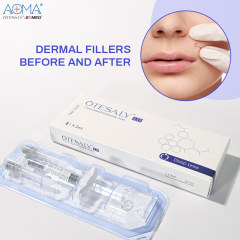 CE Approved OTESALY DEEP LINES 2ML LIDO Hyaluronic Acid Filler Nasolabial Folds
