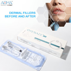 Customized OTESALY DEEP LINES 1ML LIDO Non-Surgical Lift Chin Augmentation