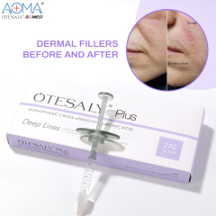 MONOPHASIC OTESALY PLUS 1ML DEEP LINES VOLUMIZING FILLER CHIN AUGMENTATION